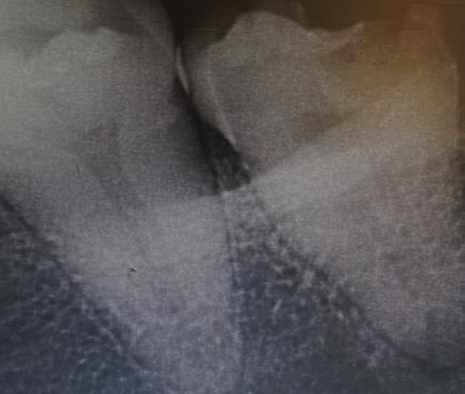 Preoperative radiograph