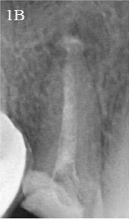 Calcium hydroxide intracanal medicament placement