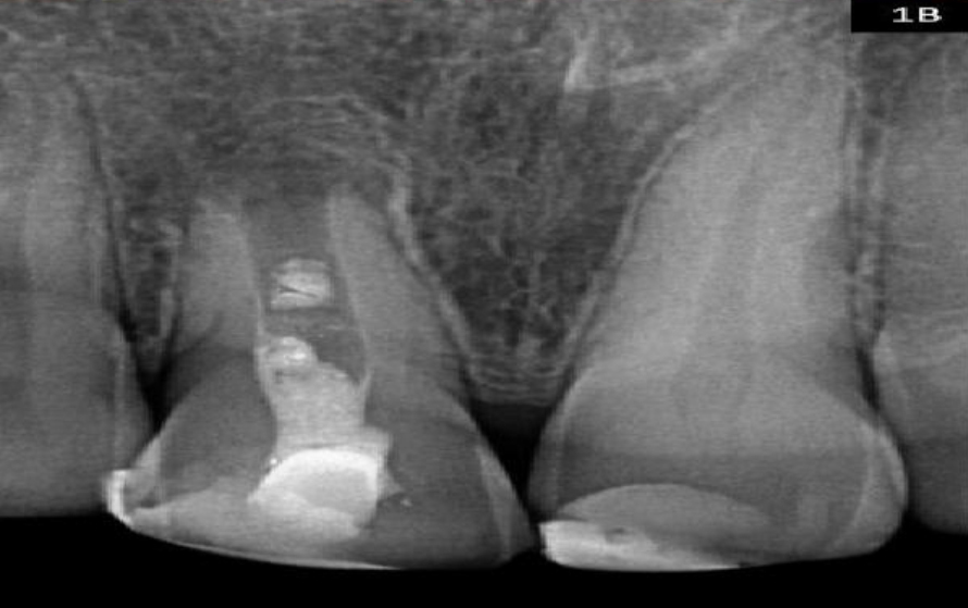 Pre-operative Radiograph