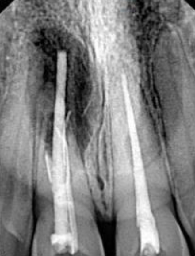 Interruption and small displacement of the filling material at the level of the middle third of the root canal and gutta-percha extruding out of the root canal