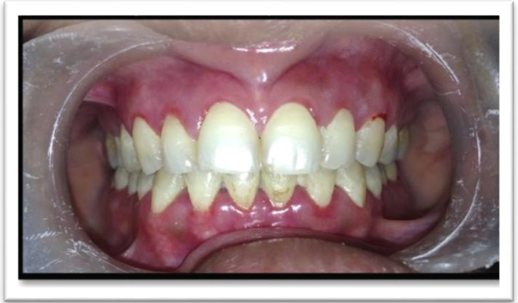 Linear gingival erythema