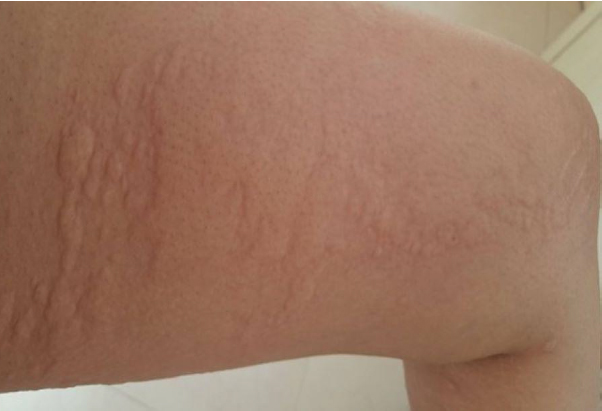 Late presentation of urticaria