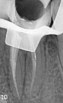 Post-Obturation radiograph