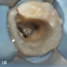 Isolation and pre-endodontic buildup