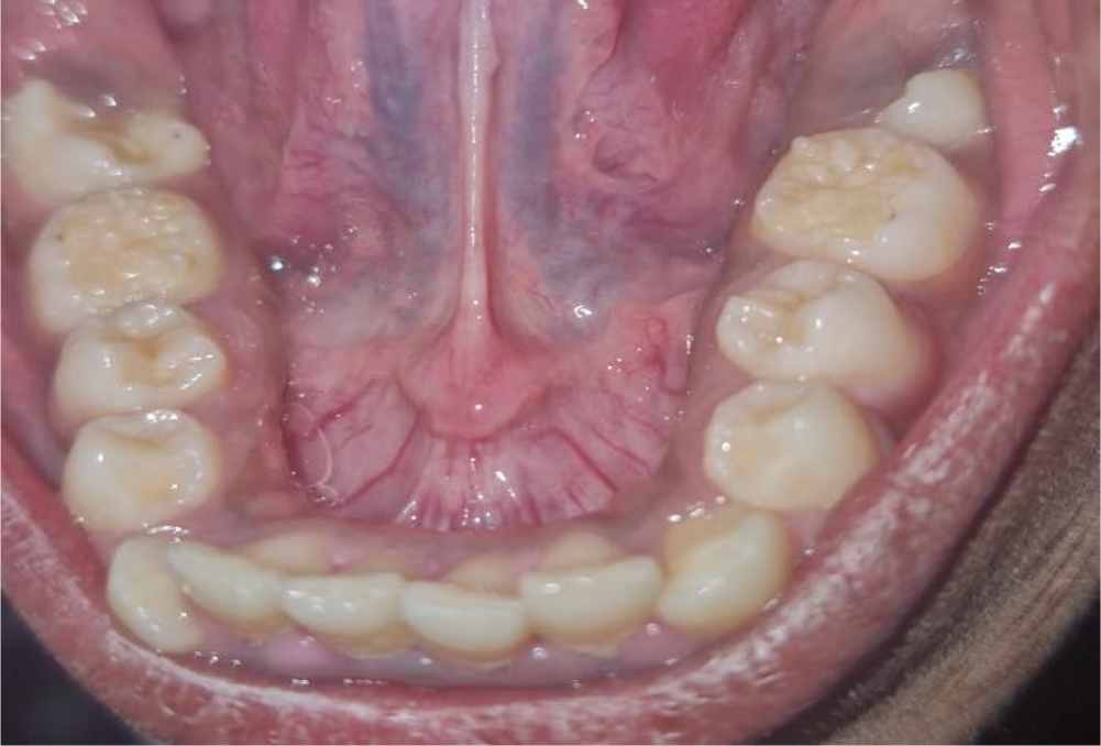 Intraoral photograph showing the lower first permanent molar with multiple globular enamel cusps, giving a characteristic mulberry appearance