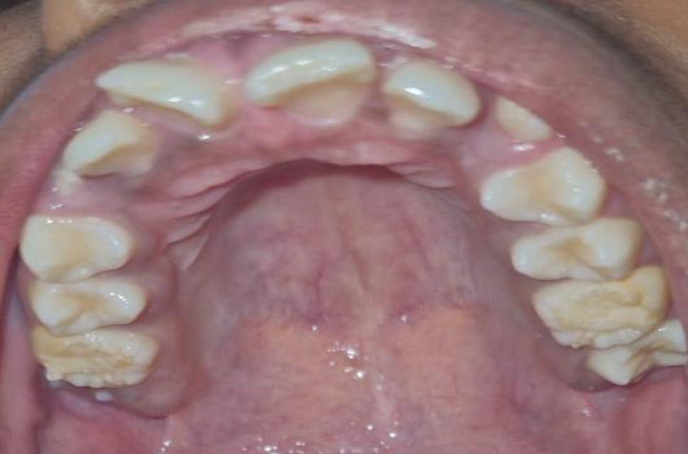 Intraoral photograph of the upper first permanent molar displaying similar globular projections on the occlusal surface