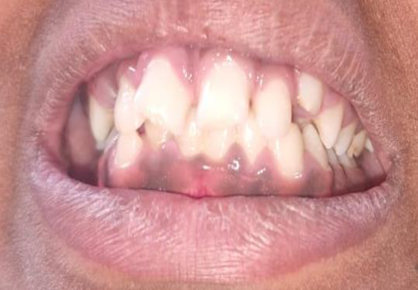 Clinical image demonstrating normal Class I occlusion in the patient