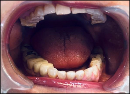 Intraoral photograph illustrating generalized attrition of the mandibular posterior teeth, characterized by flattened occlusal surfaces and areas of dentin exposure