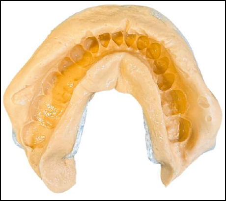 Primary impression of the mandibular arch obtained using irreversible hydrocolloid (alginate) impression material