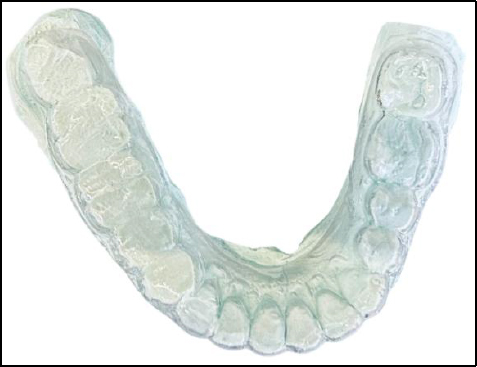 Diagnostic cast prepared from the mandibular impression for treatment planning and appliance fabrication