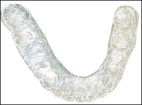 Occlusal view of the completed soft night guard after finishing and polishing