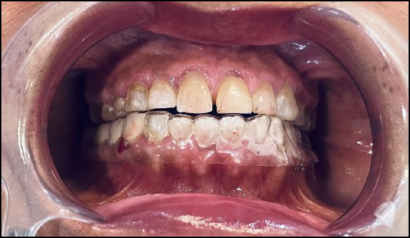 Intraoral placement of the soft night guard demonstrating proper adaptation and occlusal contact with the opposing dentition.