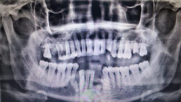 Panoramic X-ray