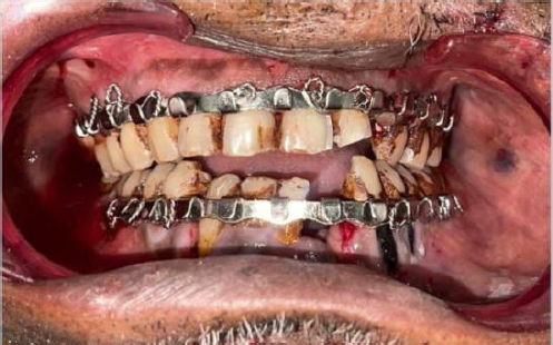 Intraoral view of the fractured mandibular area with initial stabilization using orthodontic wire