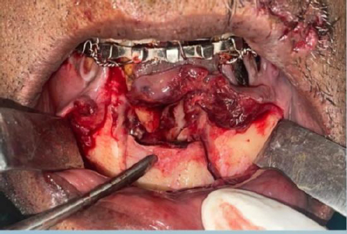 Intraoperative image showing the exposure of the fracture site and preparation for open reduction
