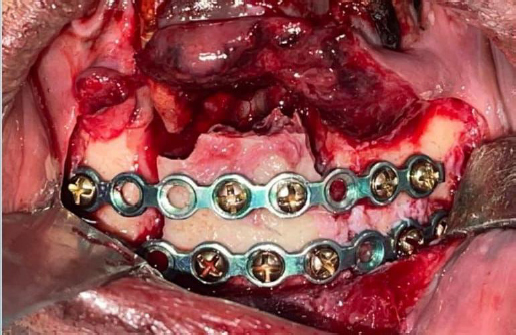 Placement of reconplate for fixation of the mandibular fragments during surgery