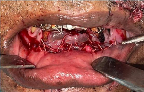 Final positioning of the reconplate and screws following reduction of the fracture