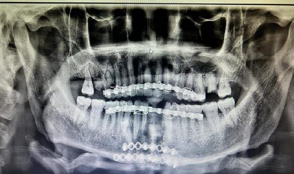 Postoperative panoramic X-ray showing successful alignment and fixation of the mandible after ORIF