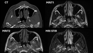 Image of Nasopharyngeal Hamartoma in Adults: A Case Report
