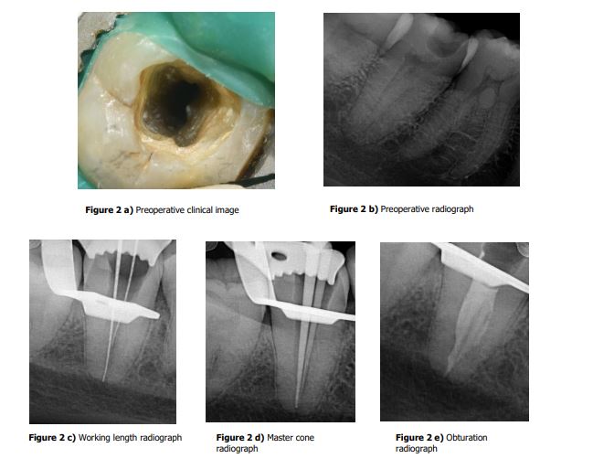 Image of Navigating the C-Shape Canals: A Case Series on Endodontic Treatment with Bio-ceramic Sealers