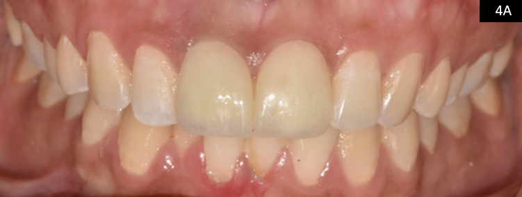 Image of Esthetic Management of a Discolored Permanent Tooth with Open Apex Using Nonsurgical Retreatment and Bio-Obturation