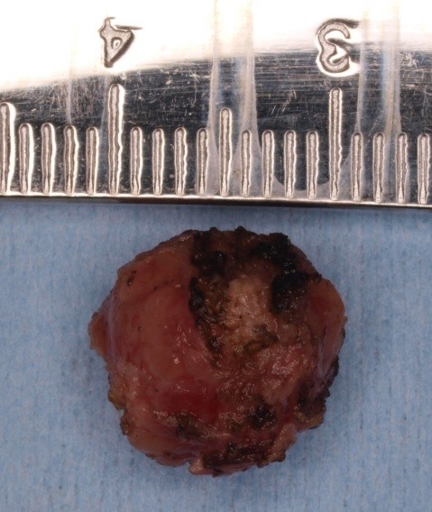 Image of Myoepithelioma in Mandibular Gingiva: A Rare Case Report