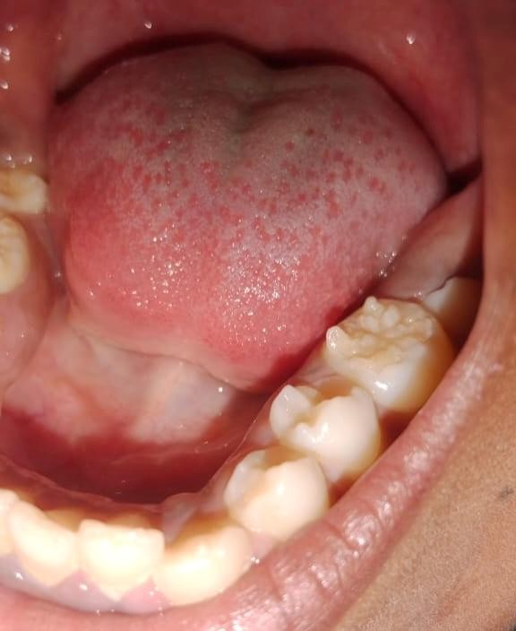 Image of Developmental Enamel Defects Mimicking Mulberry Molars in a Syphilis-Negative Patient: A Case Report